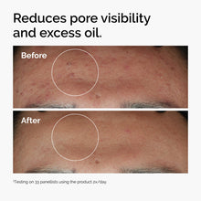 Before and after using Niacinamide 10% + Zinc 1%  to reduce oil and minimize pores.